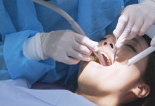 Čiščenje zobnega kamna