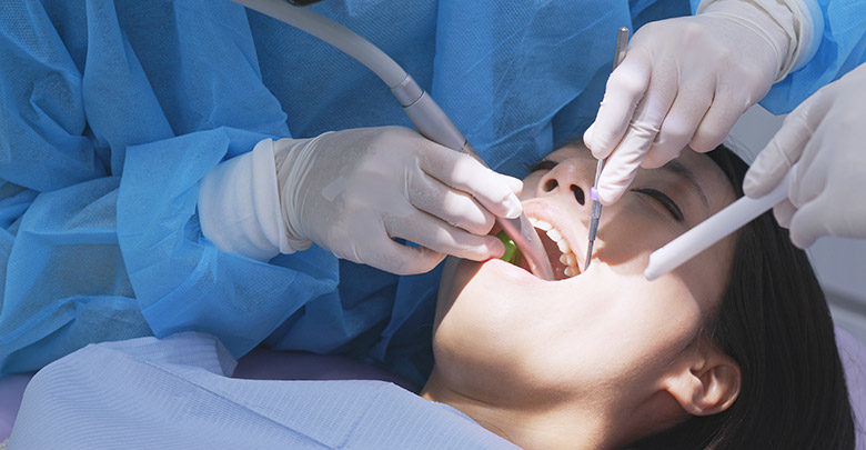 Čiščenje zobnega kamna