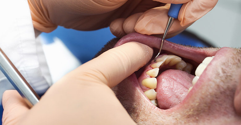 Parodontalna bolezen